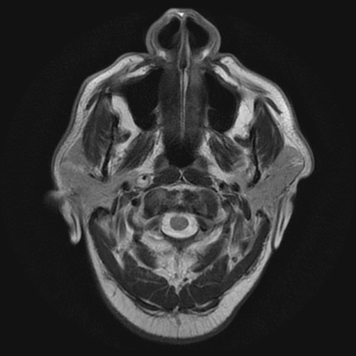 File:Carotid arterial dissection with acute cerebral infarction (Radiopaedia 26636-26784 Axial T2 1).jpg
