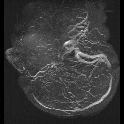 Carotid arterial dissection with acute cerebral infarction (Radiopaedia 26636-26784 MRV 19).jpg