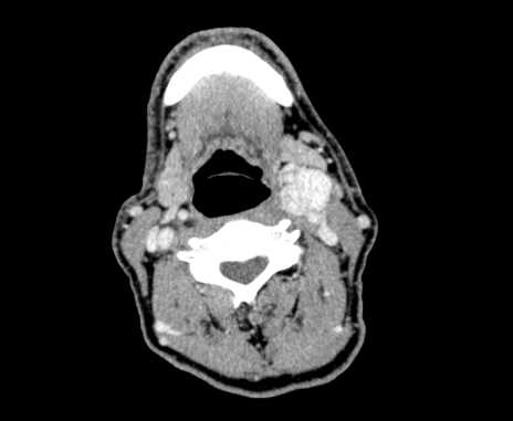 Carotid body tumor (Radiopaedia 61750-69757 Axial Post contrast 50).jpg