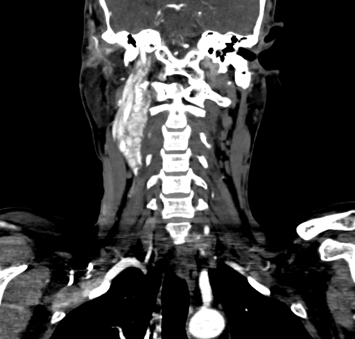 File:Carotid body tumor (Radiopaedia 83615-98727 B 75).jpg