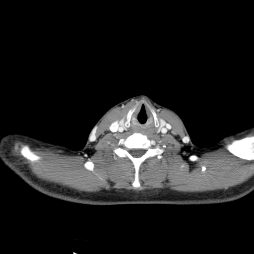 File:Carotid bulb pseudoaneurysm (Radiopaedia 57670-64616 A 52).jpg