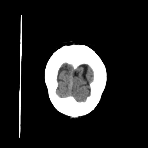 Carotid near-occlusion (Radiopaedia 85304-100887 Coronal non-contrast 69).jpg