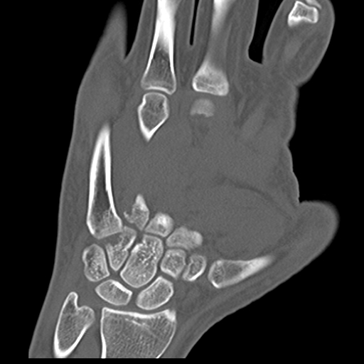 File:Carpo-metacarpal fracture-dislocations with hamatum split fracture (Radiopaedia 18482-18343 Coronal bone window 11).jpg