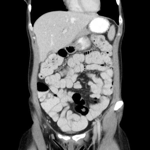 Castleman disease with fibrous pseudotumor in the abdomen (Radiopaedia 77296-89373 B 28).jpg