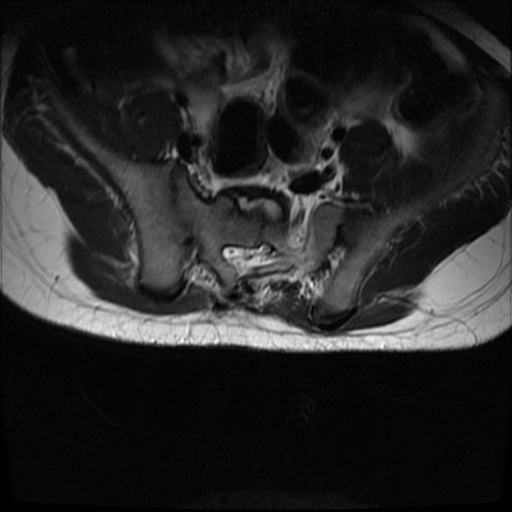 File:Caudal regression syndrome type 1 (Radiopaedia 82213-96267 Axial T2 22).jpg