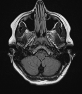 File:Cavernoma with bleed - midbrain (Radiopaedia 54546-60774 Axial FLAIR 6).png