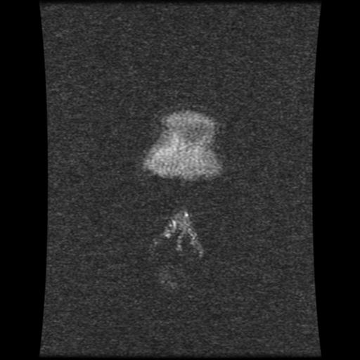 Cavernoma with developmental venous anomaly (Radiopaedia 22470-22507 MRV 125).jpg