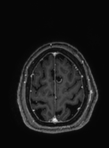 Cavernous hemangioma of the cerebellar falx (Radiopaedia 73025-83724 Axial T1 C+ 56).jpg