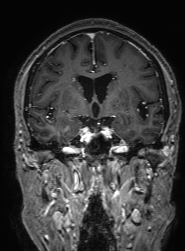 Cavernous hemangioma of the cerebellar falx (Radiopaedia 73025-83724 Coronal T1 C+ 168).jpg