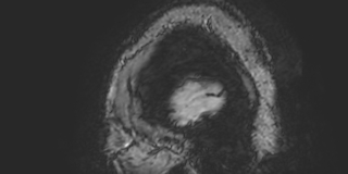 Cavernous hemangioma of the cerebellar falx (Radiopaedia 73025-83724 Sagittal BOLD 5).jpg