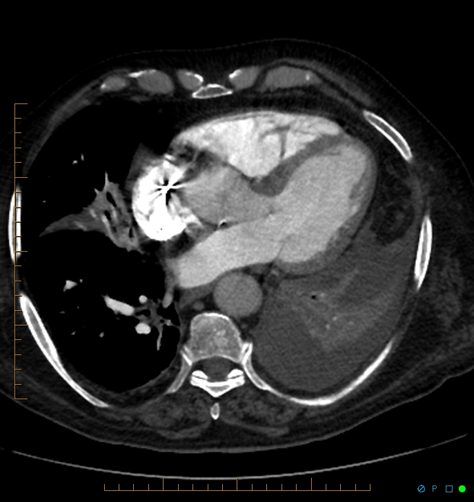 Cavitating pulmonary infarction (Radiopaedia 54634-60849 Axial C+ CTPA 54).jpg