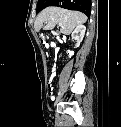 Cecal adenocarcinoma (Radiopaedia 85324-100916 E 28).jpg