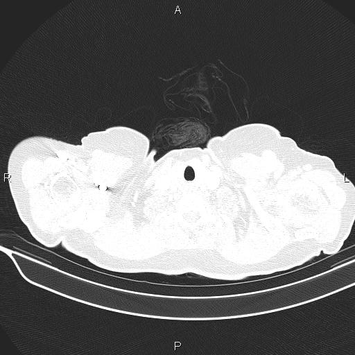 Cecal cancer (Radiopaedia 85610-101358 Axial lung window 1).jpg