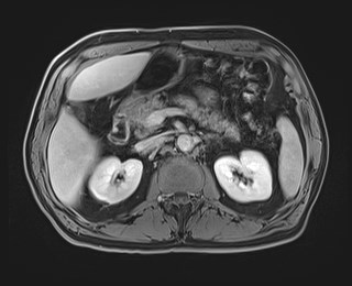 Cecal mass causing appendicitis (Radiopaedia 59207-66532 J 51).jpg