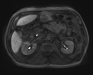 File:Cecal mass causing appendicitis (Radiopaedia 59207-66532 K 52).jpg