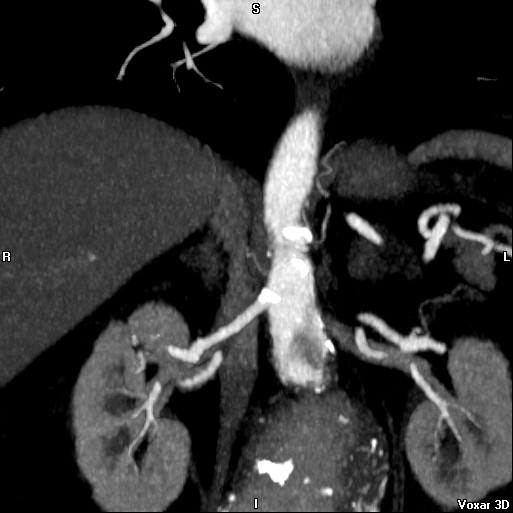 File:Celiac artery anatomy (Radiopaedia 16763-16476 A 14).jpg