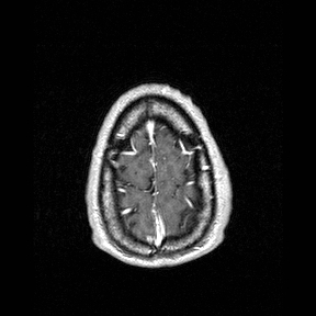 Central-variant posterior reversible encephalopathy syndrome (PRES) (Radiopaedia 43880-47358 Axial T1 C+ 157).jpg