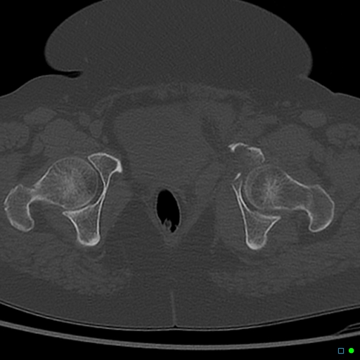 Central fracture-dislocation of the acetabulum (Radiopaedia 36578-38150 Axial bone window 67).jpg