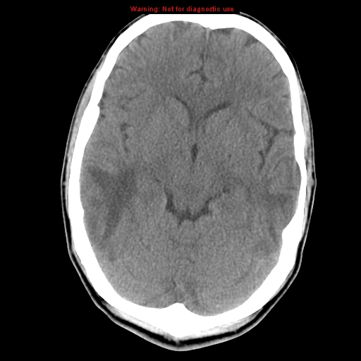 File:Central nervous system vasculitis (Radiopaedia 8410-9234 Axial non-contrast 11).jpg