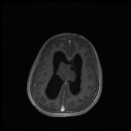 Central neurocytoma (Radiopaedia 30220-30842 Axial T1 C+ 102).jpg