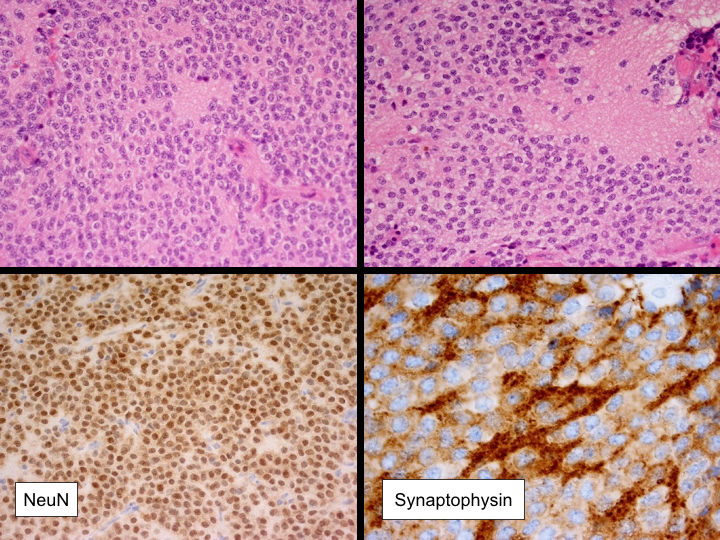 File:Central neurocytoma (Radiopaedia 37664-39585 A 1).png