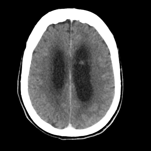 Central neurocytoma (Radiopaedia 65317-74346 Axial C+ delayed 34).png