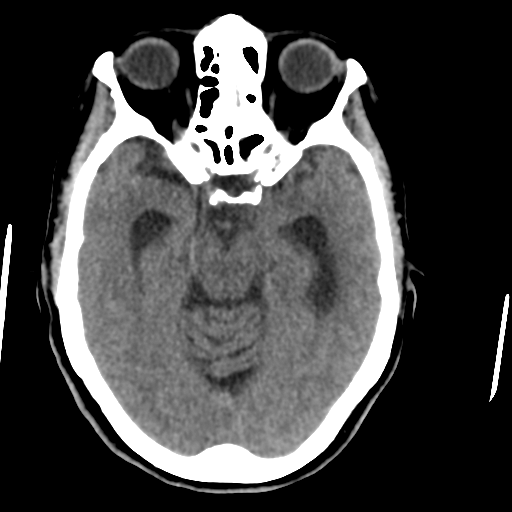 Central neurocytoma (Radiopaedia 65317-74346 Axial non-contrast 19).png