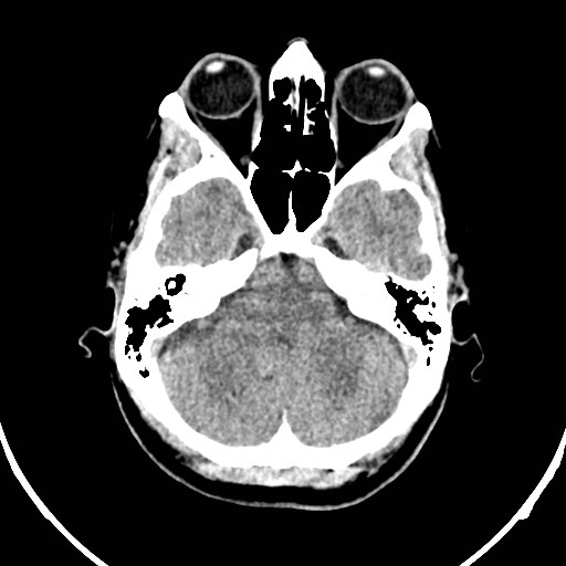Central neurocytoma (Radiopaedia 84497-99871 Axial non-contrast 9).jpg