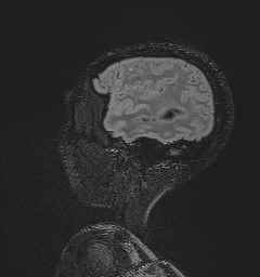 Central neurocytoma (Radiopaedia 84497-99872 Sagittal Flair + Gd 127).jpg