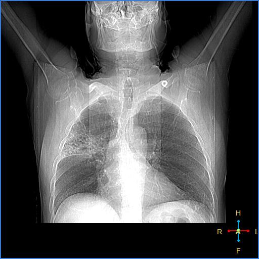 File:Centrilobular emphysema - with superimposed infection (Radiopaedia 24389-24683 Coronal CT scanogram 1).jpg