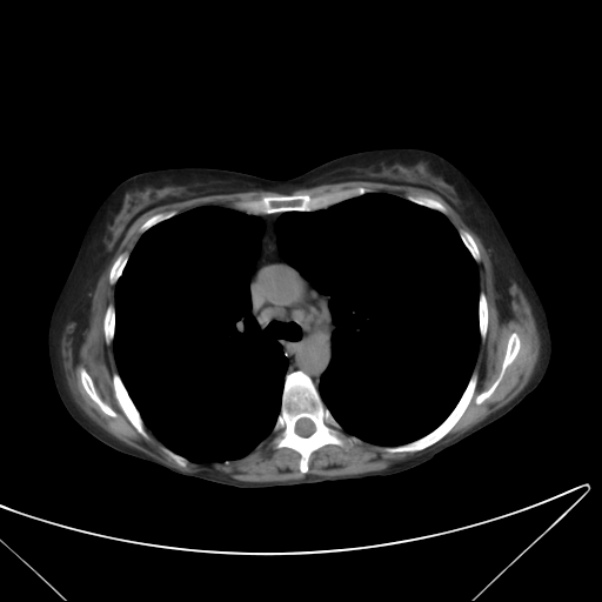 Centrilobular pulmonary emphysema (Radiopaedia 24495-24789 Axial non-contrast 19).jpg