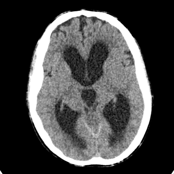Cerebellar abscess secondary to mastoiditis (Radiopaedia 26284-26412 Axial non-contrast 75).jpg