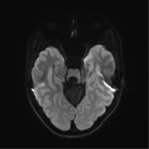 Cerebellar agenesis with hypoplastic pons (pontocerebellar hypoplasia) (Radiopaedia 57224-64138 Axial DWI 50).png