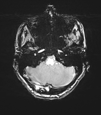 Cerebellar agenesis with hypoplastic pons (pontocerebellar hypoplasia) (Radiopaedia 57224-64138 Axial SWI 22).png