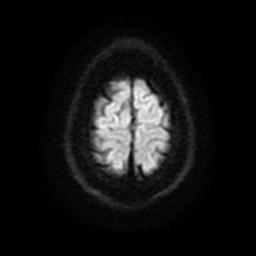 Cerebellar hemangioblastoma (Radiopaedia 29570-30077 Axial DWI 24).jpg