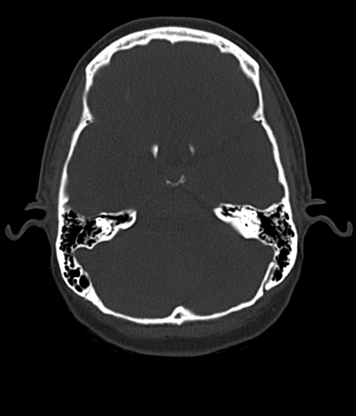 Cerebellar metastases - colorectal adenocarcinoma (Radiopaedia 40947-43652 AX Bone C- 2.0 MPR 16).png