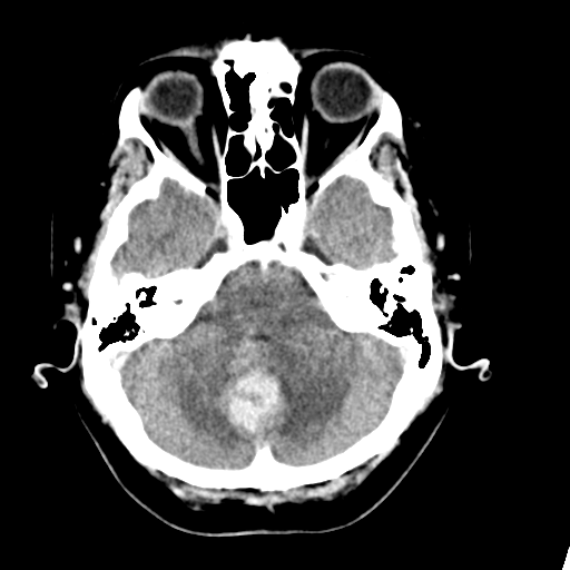 Cerebellar metastasis (Radiopaedia 54578-60812 Axial C+ 12).png