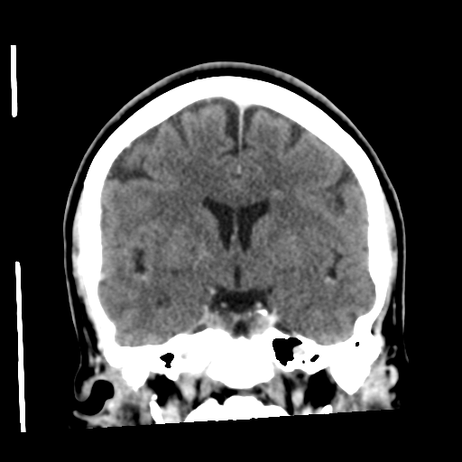 Cerebellar metastasis (cystic appearance) (Radiopaedia 41395-44258 D 30).png