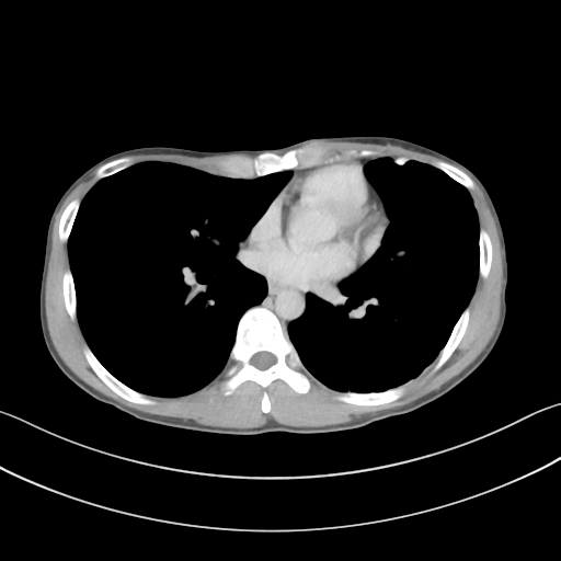 Cerebellar metastasis - adenocarcinoma lung (Radiopaedia 63184-71717 Axial C+ delayed 40).png