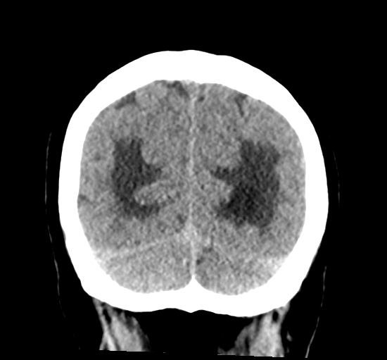 File:Cerebellar metastasis from lung adenocarcinoma (Radiopaedia 86690-102828 Coronal non-contrast 34).png