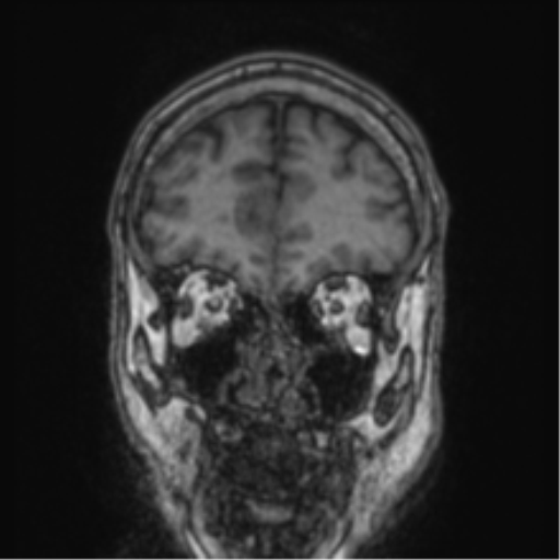 Cerebellar metastasis from lung adenocarcinoma (Radiopaedia 86690-102829 Coronal T1 80).png