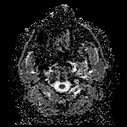 File:Cerebellar metastasis of pulmonary adenocarcinoma, cavernous venous malformation, and developmental venous anomaly (Radiopaedia 85827-101661 Axial ADC 1).jpg