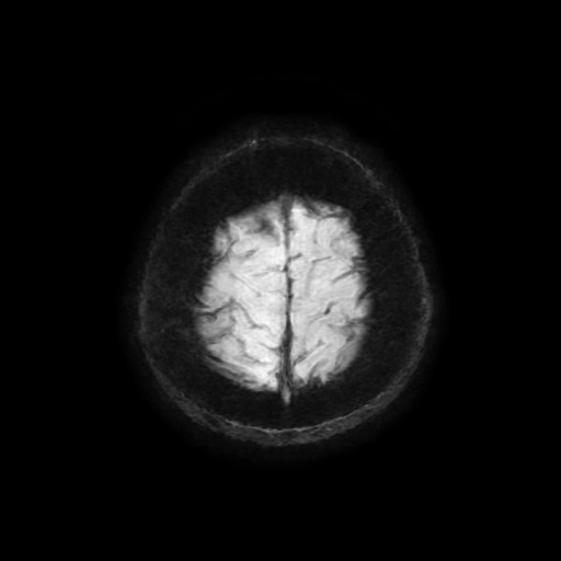 File:Cerebellar metastasis of pulmonary adenocarcinoma, cavernous venous malformation, and developmental venous anomaly (Radiopaedia 85827-101661 Axial SWI 9).jpg