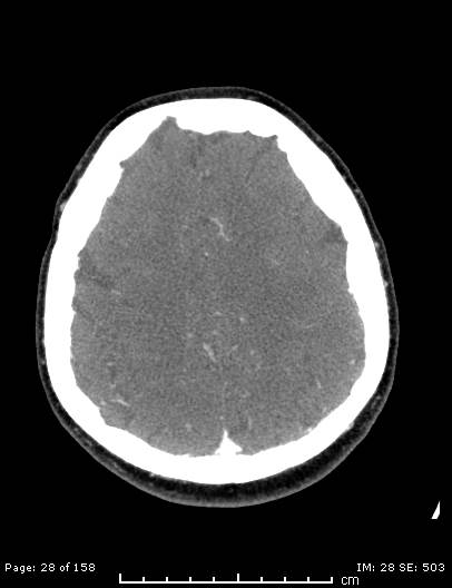 File:Cerebellar strokes due to intracranial giant cell arteritis (Radiopaedia 68799-78510 CT angiogram 28).jpg