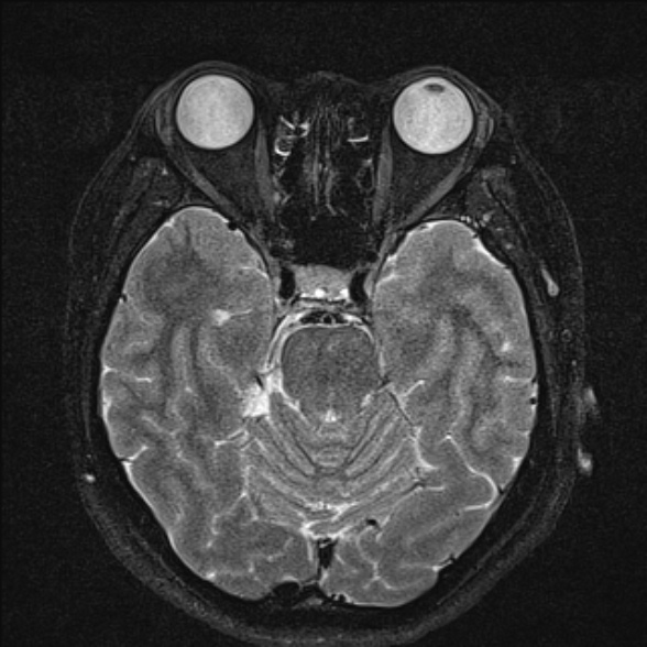 File:Cerebellopontine angle meningioma (Radiopaedia 53561-59591 Axial T2 fat sat 17).jpg