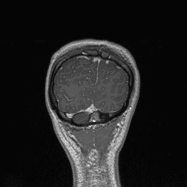 Cerebral abscess (Radiopaedia 24212-24478 Coronal T1 C+ 178).jpg
