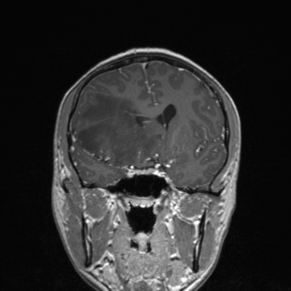 File:Cerebral abscess (Radiopaedia 24212-24478 Coronal T1 C+ 93).jpg