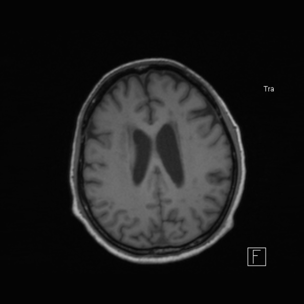 Cerebral abscess (Radiopaedia 26111-26247 Axial T1 40).jpg