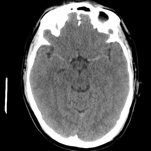Cerebral abscess (Radiopaedia 29451-29919 Axial non-contrast 20).jpg