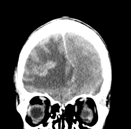 Cerebral abscess (Radiopaedia 60342-68008 Coronal C+ delayed 16).png